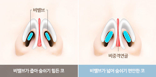 韩国鼻子做得好的整形医院推荐温度整形,顾客好评就是证明