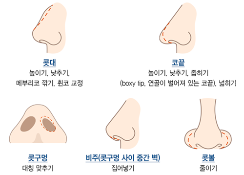 鼻子修复类型图示