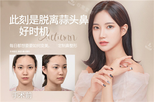 韓國GNG整形外科鼻整形前后圖 韓國GNG整形外科鼻整形前后圖
