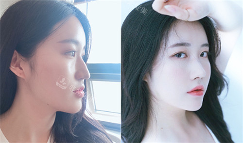 韩国GNG整形外科鼻整形前后图