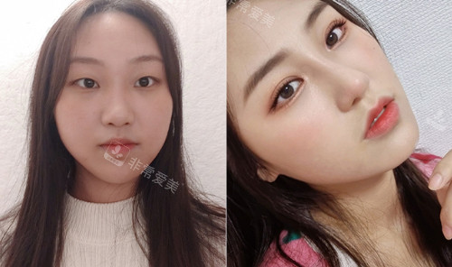 韩国GNG整形外科鼻部整形前后对比