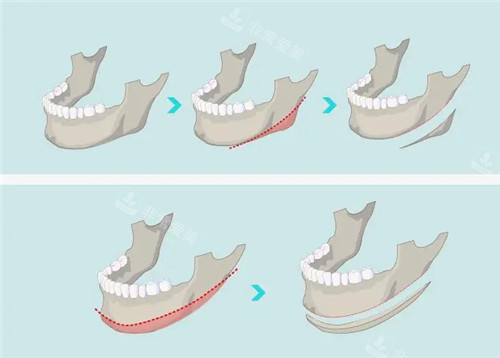 不同下颌角整形术式