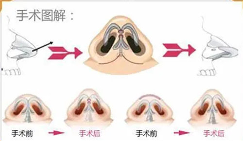 鼻翼缩小手术步骤图