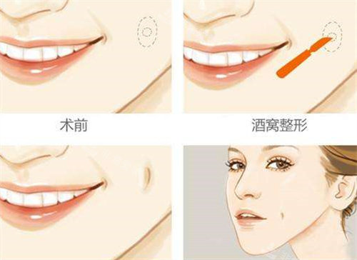韓國(guó)芭堂整形醫(yī)院酒窩整形過(guò)程圖 韓國(guó)芭堂整形醫(yī)院酒窩整形過(guò)程圖