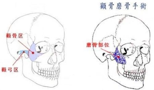 顴骨手術(shù)示意圖 顴骨手術(shù)示意圖
