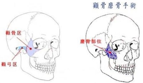 颧骨手术示意图