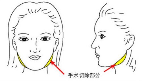 下颌角手术示意图