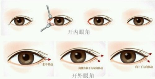 開(kāi)眼角示意圖