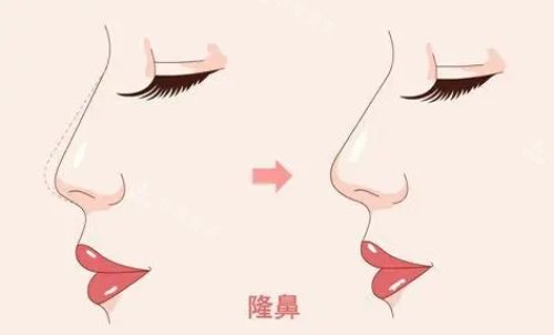 隆鼻示意圖