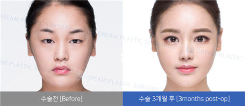 韩国梦想整形外科眼部手术照片