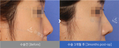 韩国梦想整形外科鼻子整形手术照片