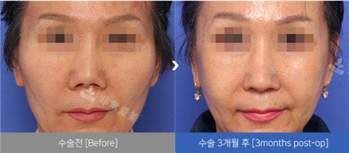 韩国梦想整形医院日记公开，含眼鼻脂肪填充手术前后图片