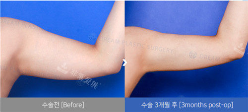 韩国梦想整形外科手臂吸脂手术照片
