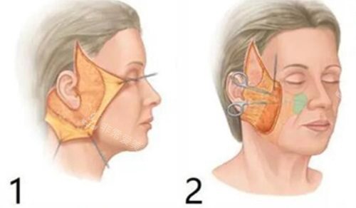 面部拉皮剥离图