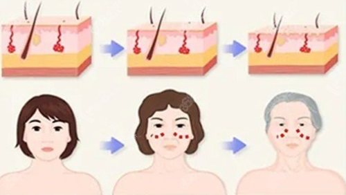 面部拉皮原理图 面部拉皮原理图