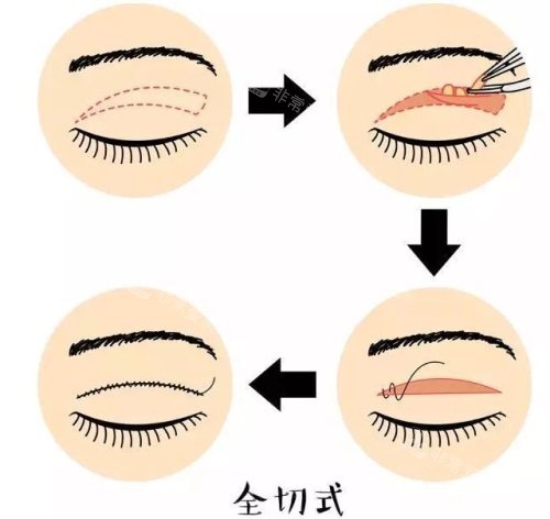 全切雙眼皮示意圖