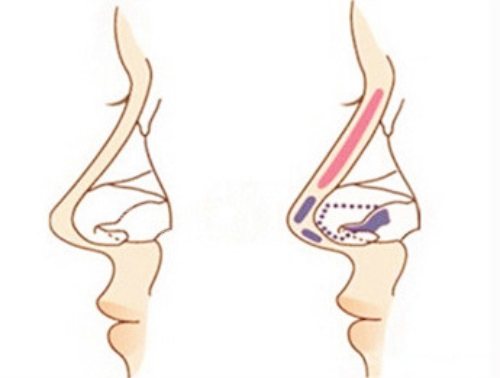 隆鼻示意圖