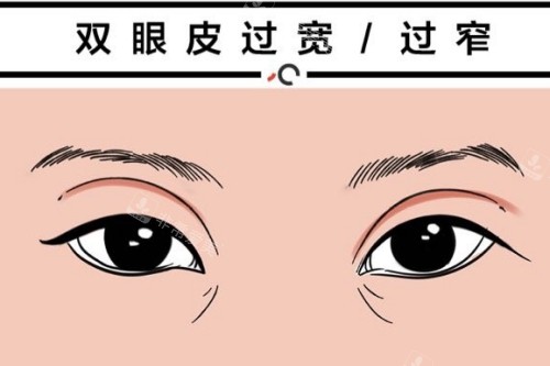 雙眼皮線條夸張 雙眼皮線條夸張