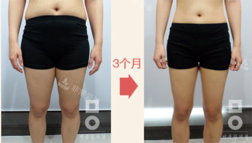 韓國(guó)美爾韓醫(yī)院腿部前后對(duì)比 韓國(guó)美爾韓醫(yī)院腿部前后對(duì)比