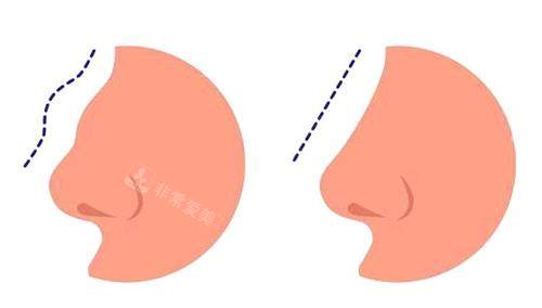 新疆华美整形医院隆鼻示意图