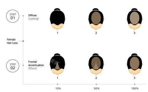 女性脱发步骤示意图