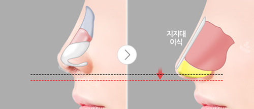 鼻子和面部美学设计图示