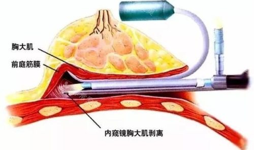 内窥镜隆胸技术