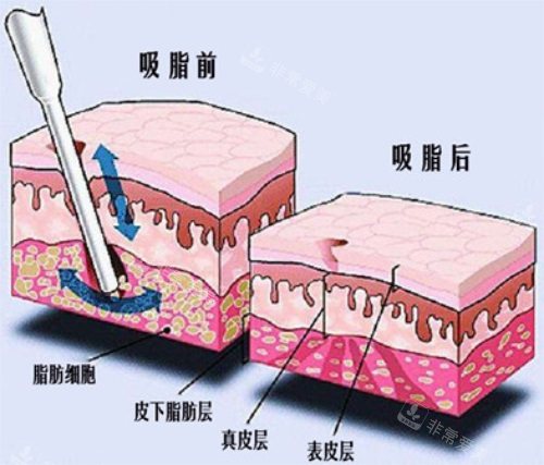 吸脂前后脂肪对比