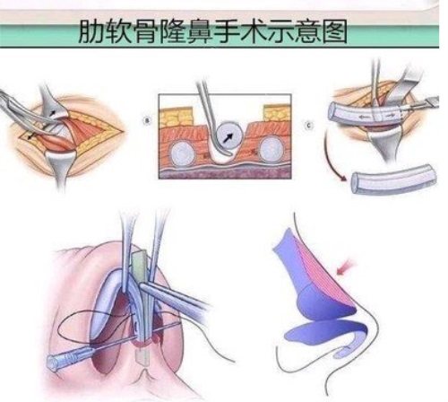 肋骨隆鼻手术示意图