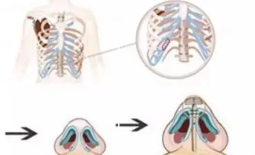 肋骨鼻示意图