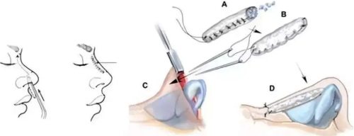 隆鼻过程图