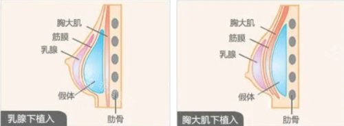 假体隆胸植入位置示意图 假体隆胸植入位置示意图