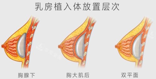 乳房植入体放置层次图