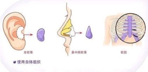 耳軟骨隆鼻示意圖 耳軟骨隆鼻示意圖