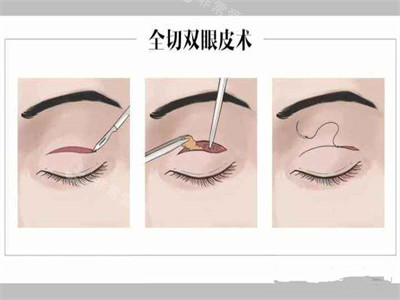 全切雙眼皮術(shù)過程