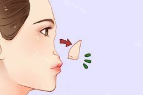 鼻部手术操作卡通图