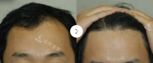韩国布莱克毛发医院男士发际线种植