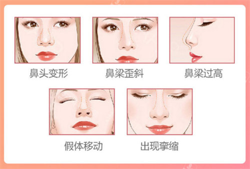 隆鼻失敗適應(yīng)癥 隆鼻失敗適應(yīng)癥