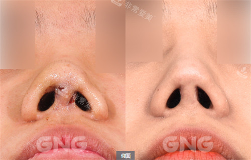 韩国GNG整形医院挛缩鼻修复对比