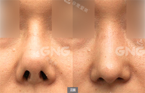 韩国GNG整形医院挛缩鼻修复对比