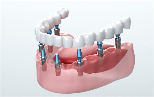 半口种植牙图示