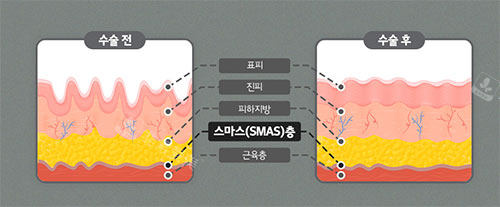 皮膚smas筋膜層示意圖 皮膚smas筋膜層示意圖