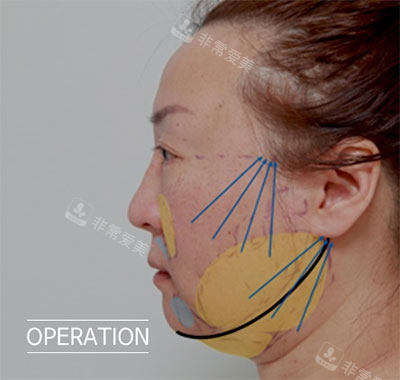韩国抗衰老医院分享：延世多仁切开法SMAS面部紧致提拉