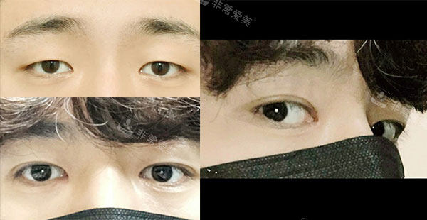 韩国icon埋线双眼皮手术