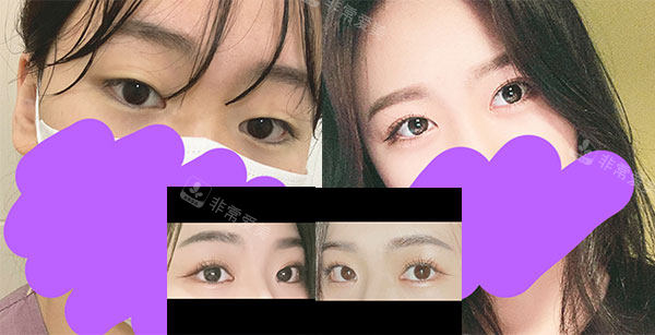 韩国icon整形埋线双眼皮恢复照