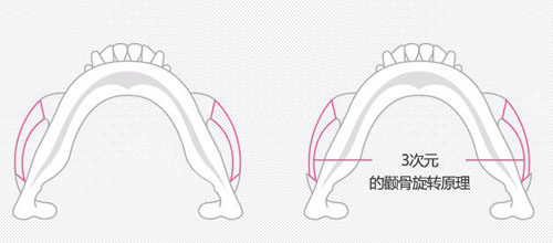 韩国NJH卢钟勋整形颧骨缩小手术特点展示