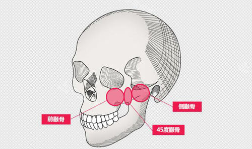 韩国NJH卢钟勋整形颧骨缩小部位示意图