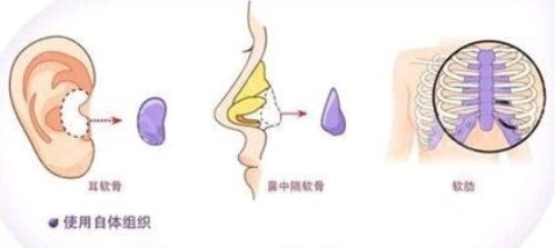 自體軟骨隆鼻示意圖 自體軟骨隆鼻示意圖