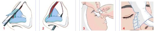 隆鼻手術過程示意圖