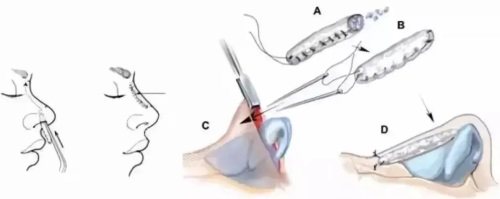 隆鼻缝合过程